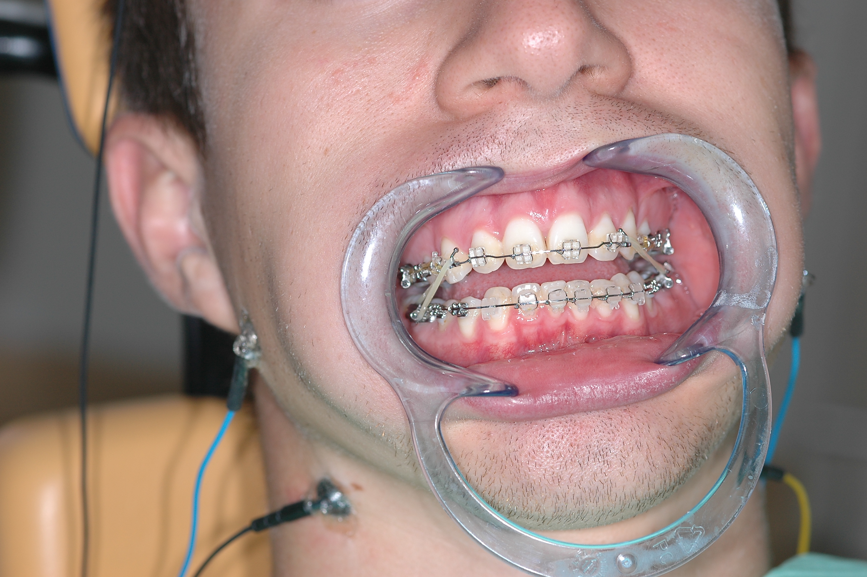 Traitements orthodontiques fixes